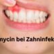Clindamycin bei Zahninfektionen: Was man wissen sollte