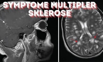 Die Auswirkungen von Symptome Multipler Sklerose auf Ihren Körper