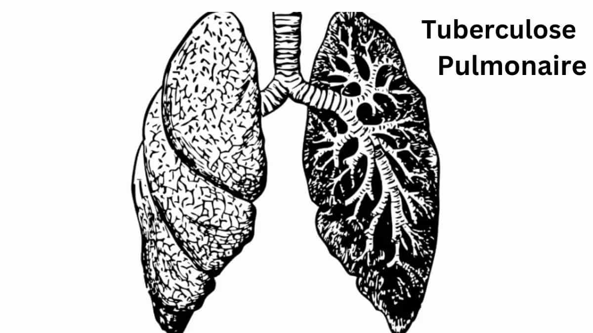 la tuberculose pulmonaire médicamenteuse en France