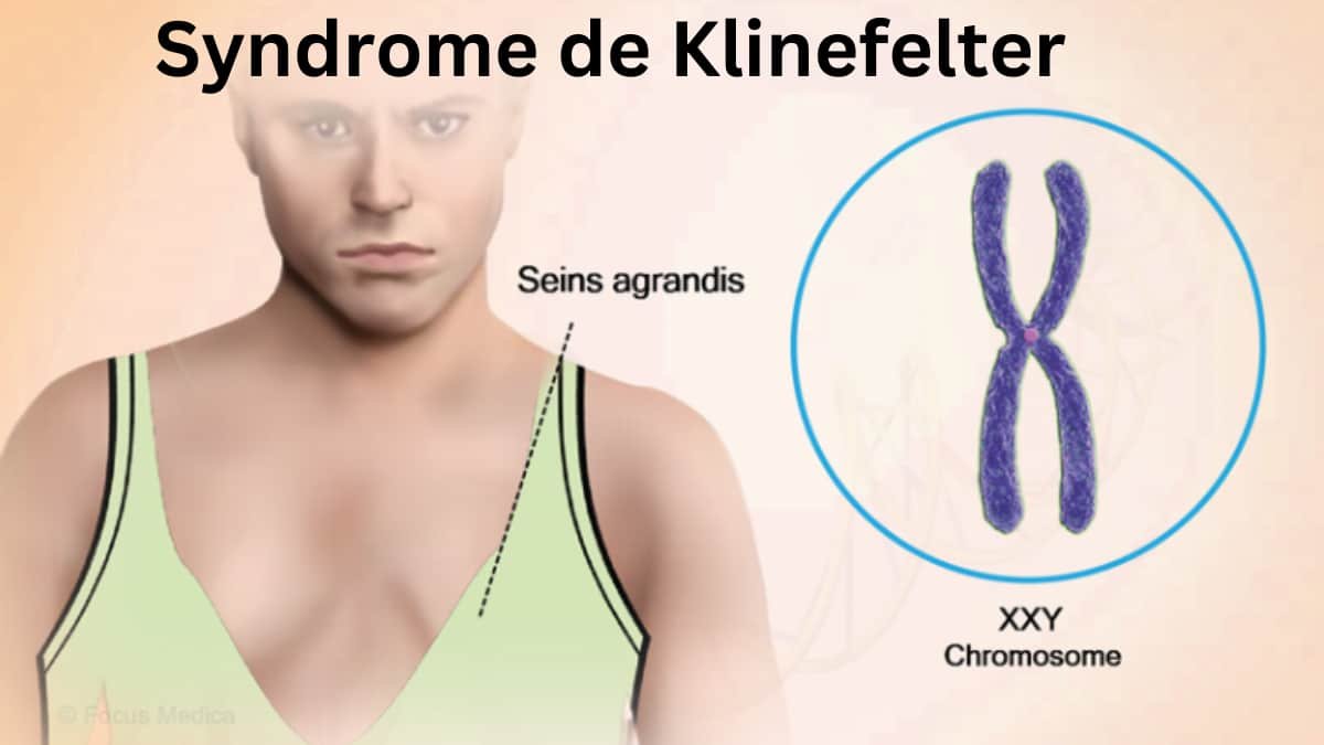 Syndrome de Klinefelter: Symptômes, Complications, Diagnostic expliqué