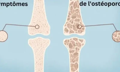 Symptômes de l'ostéoporose en french