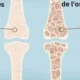 Symptômes de l'ostéoporose en french
